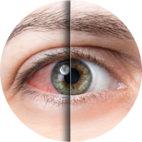 que es el desprendimiento de retina